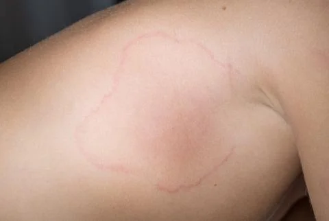 Close-up image of the body of a boy suffering from severe hives 스톡 사진