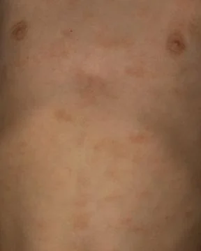 Close-up image of human skin with multiple moles, highlighting natural skin.. Stock Photos