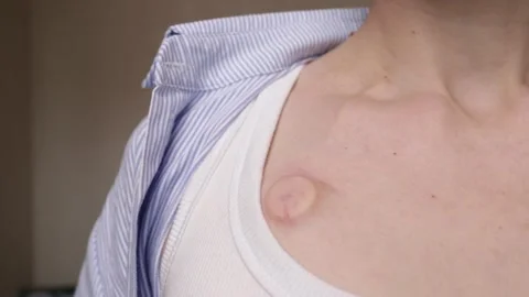 Close-up of an implanted chest port above a white tank top, showing how tre.. Stock-Footage 336071718