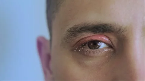 Close-up of an infected eye, showing redness. Eye condition covered by medical i Stock Footage 276183000