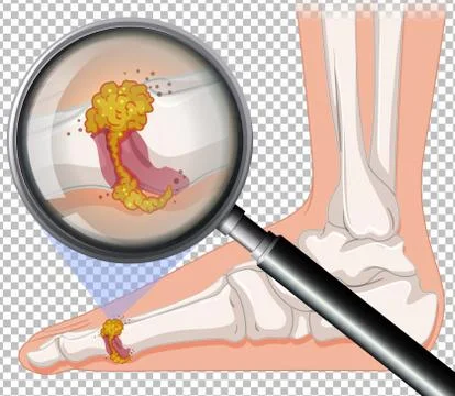 Close up of infection on foot Stock Illustration