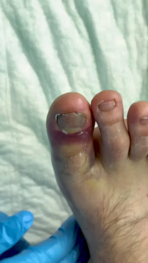 Close-up of an inflamed and bruised human toe being examined with gloved hand Stock Footage 335524258