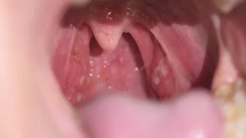 Close-up of inflamed tonsils and uvula with visible pus from throat infection Stock Footage 307843346