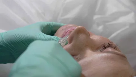 Close-up injection syringe to increase lip fullness Stock Footage 136744133