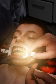 Close up of installing braces on teeth, aligning teeth with braces, retractor Fotos de archivo