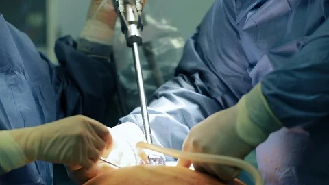 Close up of installing laparoscopy camera surgery robot in surgical room in h 動画素材 102186193