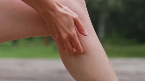 Close-up itching of a mosquito or other insect bite. Swelling and allergies to Stock Footage 279962541