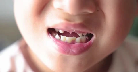 Close up of kid smiling with missing front tooth, child dental care, milk t.. Stock Footage 310980452