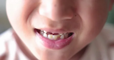 Close up of kid smiling with missing front tooth, child dental care, milk t.. Stock Footage 310980550