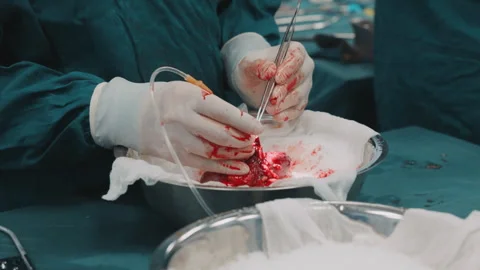 Close-up of a kidney transplant procedure in an operating room, showing surgeons Stock Footage 328305210