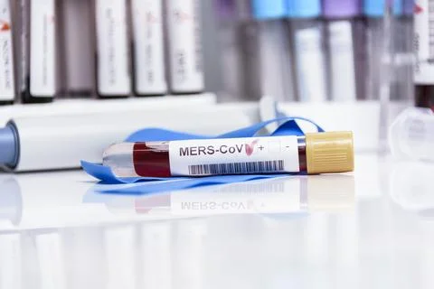 Close-up of laboratory sample positive for MERS-CoV infection. Stock Photos