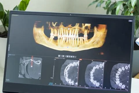 Close-Up of Laptop Screen Displaying 3D Dental CBCT Computed Tomography Dia.. Stock Photos