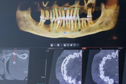 Close-Up of Laptop Screen Displaying 3D Dental CBCT Computed Tomography Dia.. Stock Photos