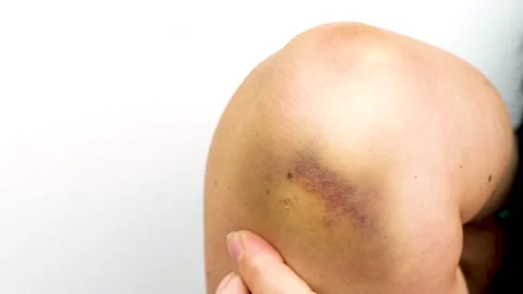Close Up of Large Healing Bruise or Hematoma on Arm Being Touched by Finger Stock-Footage 322114045