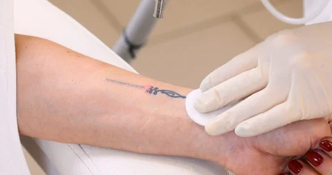 Close-up of laser tattoo removal  Видео 102028711