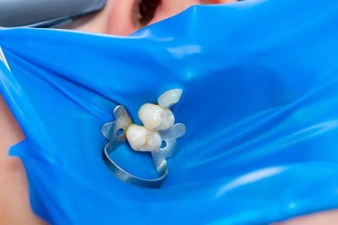 Close-up latex plate designed to isolate the tooth to be treated from the rest Stock Photos