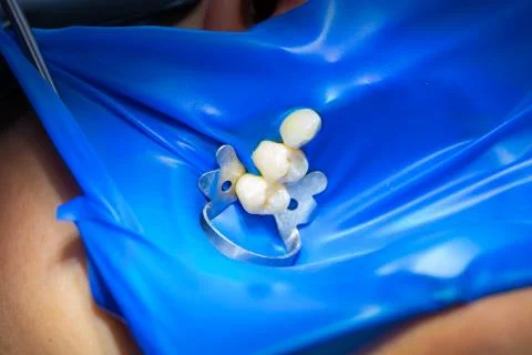 Close-up latex plate designed to isolate the tooth to be treated from the rest Stock Photos