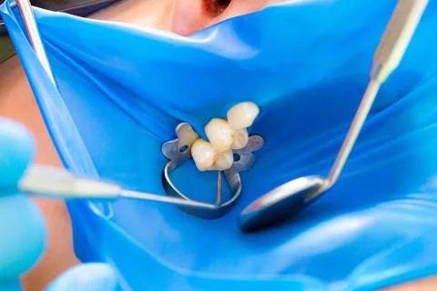 Close-up latex plate designed to isolate the tooth to be treated from the rest Stock Photos