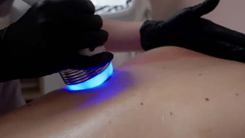Close-up of LED Light Therapy on Skin Stock Footage 262360518