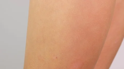 Close up leg affected by atopic dermatitis. Redness of the skin with allergies Stock Footage 102061677