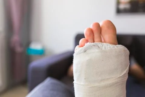 Close-up on a leg in a cast Stock Photos