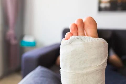 Close-up on a leg in a cast Stock Photos