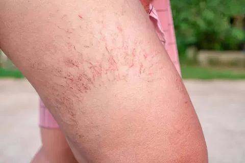 Close-up of leg with stretch marks and skin texture Stock Photos