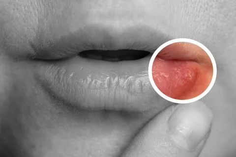 Close up of Lip Affected by Herpes Simplex Virus Infection Stock Photos