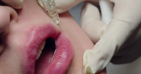 Close-up lip augmentation injection. Cosmetologist injects filler into woman's Stock-Footage 260083015