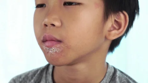 Close up of lips affected by herpes and apply medical cream. 库存影片 87782329