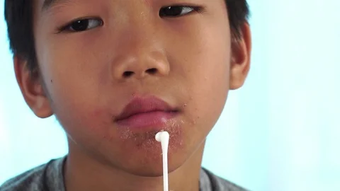 Close up of lips affected by herpes and apply medical cream. Stock Footage 88194773