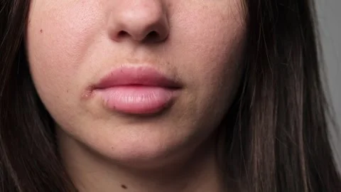 Close-up of lips with a cold sore. Detailed close-up of a person's lips with a Stock Footage 307755986