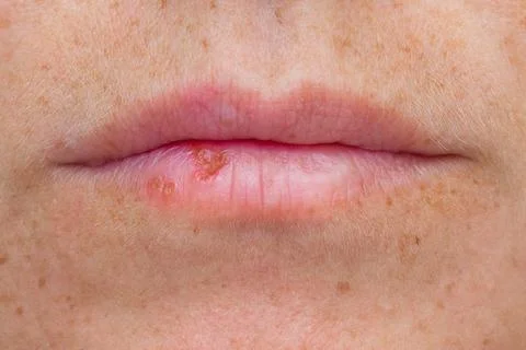 Close up lips with herpes Stock Photos