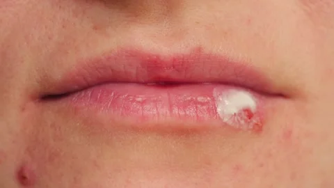 Close-up of lips with ointment applied to herpes sores. Treating herpes on the Stock Footage 320466693