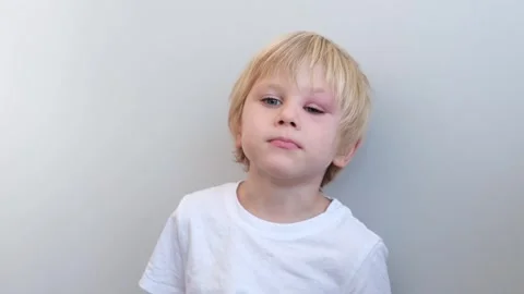 Close up little boy with allergic red spot at face cause by mosquito bite Stock Footage 321406744