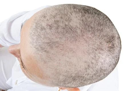 Close Look at Chemotherapy's Effects: Capturing Hair Loss 25 Days into Treatment Stockfoto's
