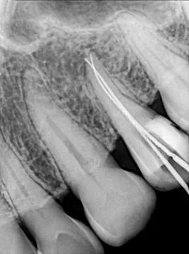 Close-up low resolution X-Ray image of human canine teeth Stock-Fotos