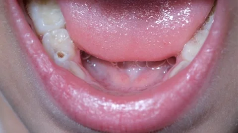 Close Up of a Lower Right First Molar Cavity of a  4-Year-Old Girl Stock Footage 315285663