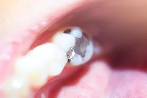 Close up macro photo of Metall amalgam dental fillings Stock Photos