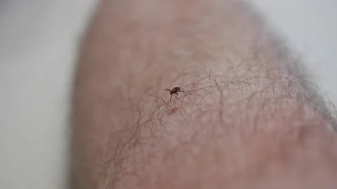 Close up macro shoot of a small tick crawling on hairy human skin, illustrating 스톡 동영상 346018625