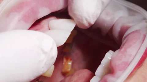 Close-up macro shot of installing dental ceramic crowns to female patient Stock Footage 270533932