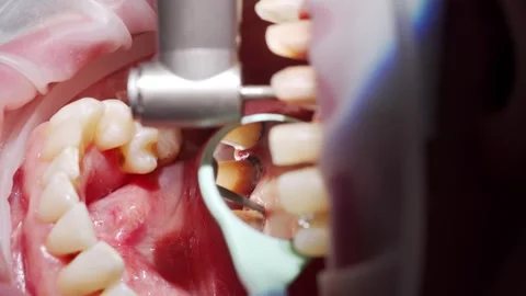 Close-up macro shot of preparing woman's teeth for installing zirconia veneers Stock Footage 272309860