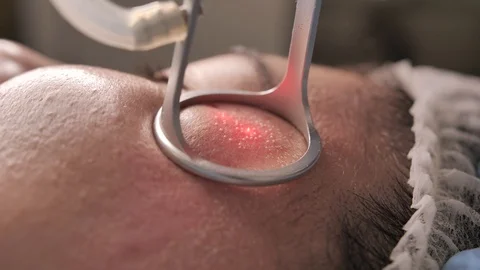 Close up macro shot of woman's face having a laser skin treatment in a skincare Stock Footage 123927205