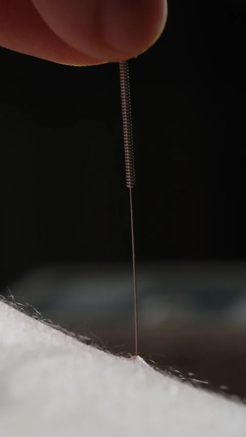 Close-up macro showing a practitioner gently inserting a fine acupuncture needle Stock Footage 328998343
