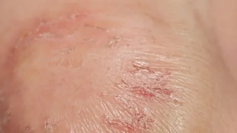 Close-Up Macro View Of Dry Cracked Flaky Human Skin With Eczema Vídeos de archivo 346954076