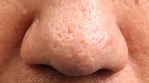 Close up macro view of a human nose showing skin problems. Enlarged pores a.. 库存照片