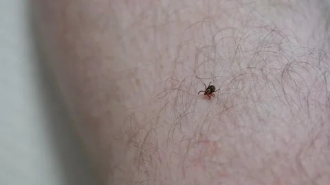 Close up macro view of a small tick crawling on hairy human skin, illustrating Vidéo 345475361