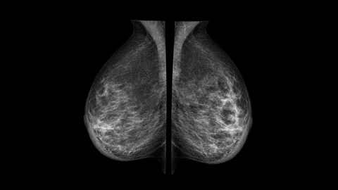 Close up of Mammogram X Ray Analysis. 库存影片 112224045