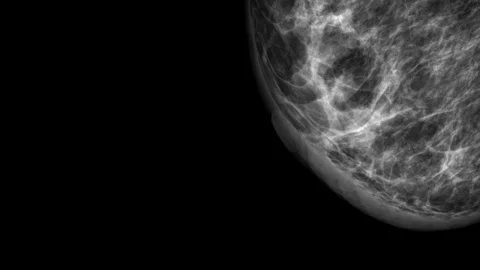 Close up of Mammogram X Ray Analysis. Vidéo 112224050