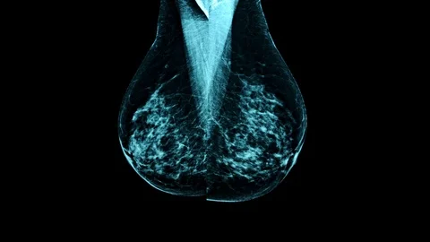 Close up of Mammogram X Ray Analysis. Vidéo 112224094